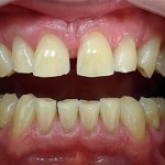 Dents blanches. שיניים מחומצנות